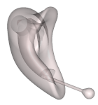 Ex-Hörer Otoplastik